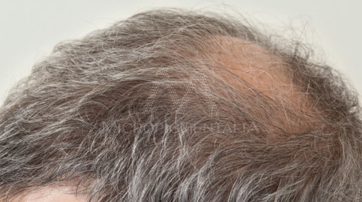 Antes · Capilar