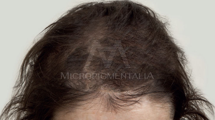 Tratamiento capilar de micropigmentación