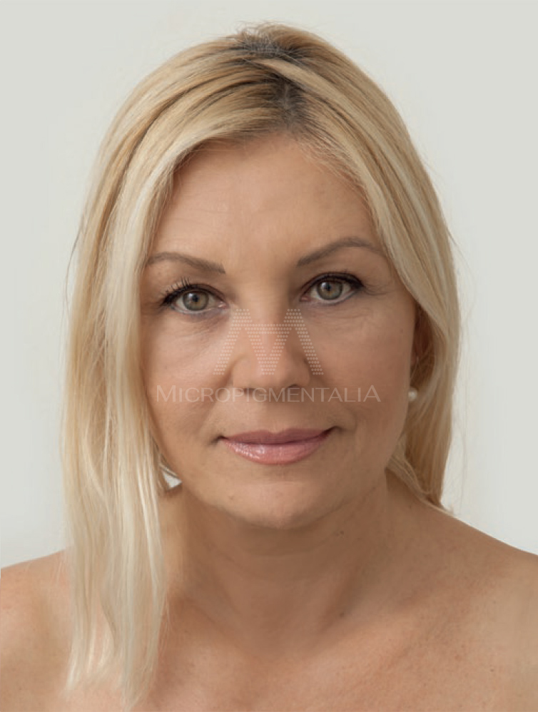 Después · Estéticos