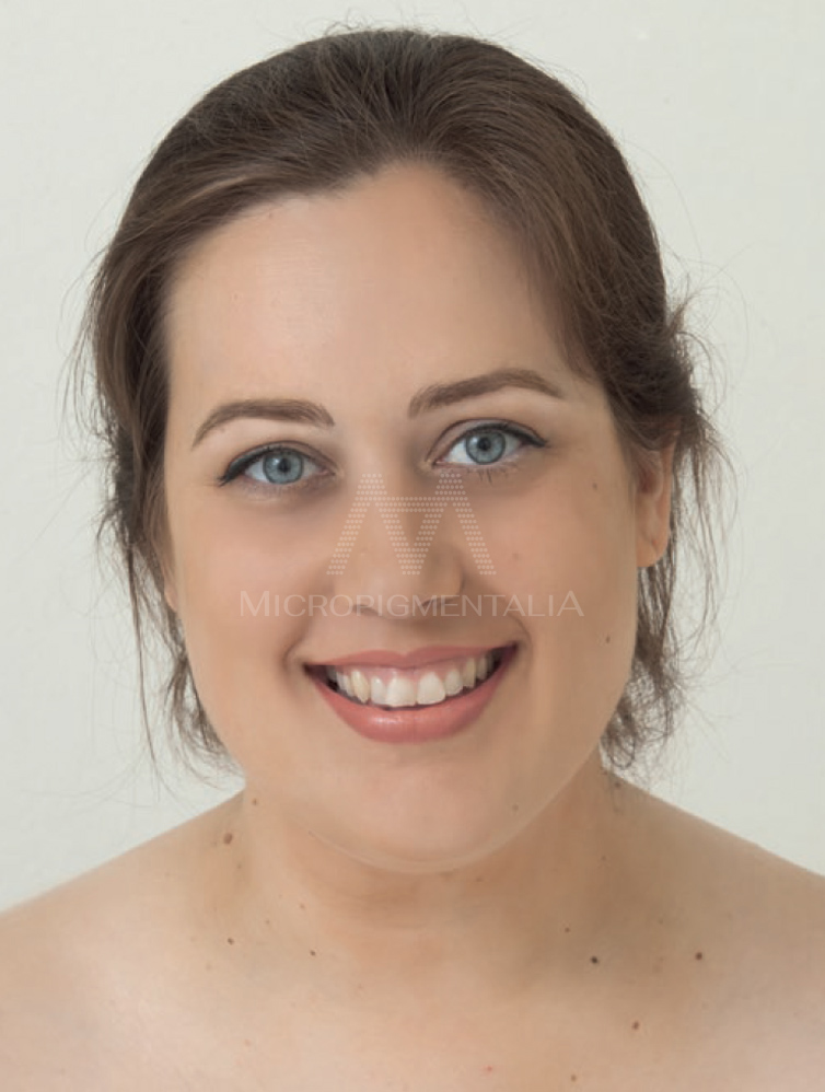 Después · Estéticos