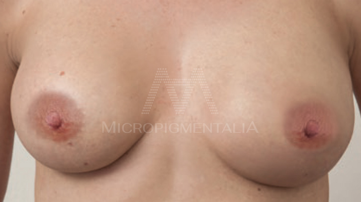 Después · Oncológico