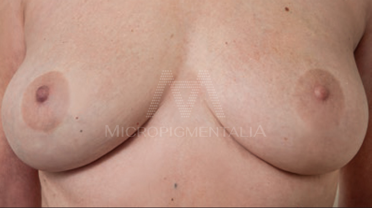 Tratamiento oncológico de micropigmentación